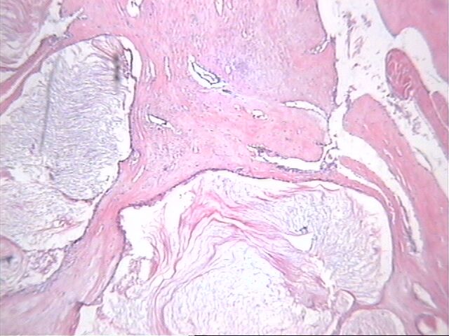 Fig.7   Metaplasia escamosa y quistes crneos - <div style=